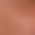 Elastoidosis cutanea nodularis et cystica. Detailvergrößerung: Multiple offene Komedonen an den W...