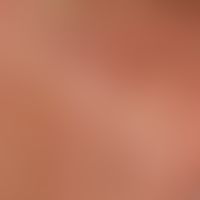 Elastoidosis cutanea nodularis et cystica. detail enlargement: multiple open comedones on the che...