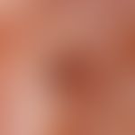 Elastoidosis cutanea nodularis et cystica. Auflichtmikroskopie ohne Kontaktmedium (Jochbogenregio...