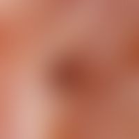 Elastoidosis cutanea nodularis et cystica: Reflected light microscopy without contact medium (zyg...