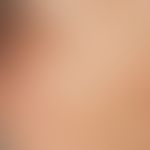 Elastosis actinica. Tiefe rhomboide Falten, mit wulstigem Hautrelief, bei blass-gelblicher Hautfä...