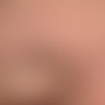 Elastosis actinica. Supraorbitale Elastose bei einer 71-jährigen Patientin. Diskrete, vermehrte F...