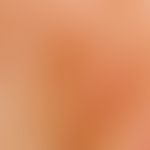 Elastosis actinica. Auflichtmikroskopie (Halsregion): Parallelstreifige Verziehung der Hautfelder...