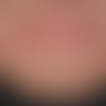 Elastosis actinica. Vermehrte, teife Faltenbildungen mit&nbsp;rhomboider Hautfelderung. Chronisch...