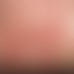 Elastosis perforans serpiginosa. Multiple, im Nackenbereich bei einem 18-jährigen Mann lokalisier...