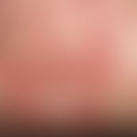 Elastosis perforans serpiginosa. Multiple, im Nackenbereich bei einem 18-jährigen Mann lokalisier...