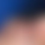 Thrombangiitis obliterans. 46-year-old patient with severe nicotine abuse lasting for decades and...
