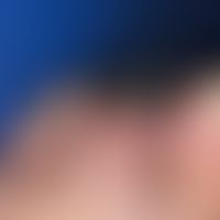Thrombangiitis obliterans. 46-year-old patient with severe nicotine abuse lasting for decades and...