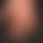 Thrombangiitis obliterans. 32-year-old patient with years of nicotine abuse and patchy palmar ery...