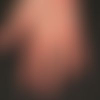 Thrombangiitis obliterans. 32-year-old patient with years of nicotine abuse and patchy palmar ery...