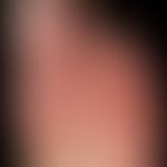 Thrombangiitis obliterans. 32-year-old patient with years of nicotine abuse and patchy plantar ry...