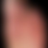 Thrombangiitis obliterans. 32-year-old patient with years of nicotine abuse and patchy plantar ry...