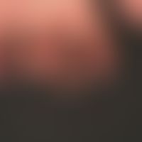 Thrombangiitis obliterans. 32-year-old patient with a nicotine abuse lasting for years and a patc...