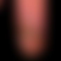 Thrombangiitis obliterans (endangiitis obliterans): peripheral circulatory disorder with acutely ...