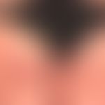 Enteritis regionalis, Hautveränderungen,&nbsp;chronische, akneiforme, follikuläre und parafolliku...