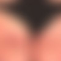 Enteritis regionalis, Hautveränderungen,&nbsp;chronische, akneiforme, follikuläre und parafolliku...