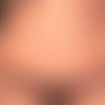 Enteritis regionalis, Hautveränderungen,&nbsp;chronische, akneiforme, follikuläre und parafolliku...