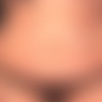 Enteritis regionalis, Hautveränderungen,&nbsp;chronische, akneiforme, follikuläre und parafolliku...