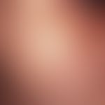 Ephelids: Spatter-like distributed, yellowish-brownish, smooth spots in the zygomatic arch region...