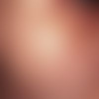 Epheliden: Spritzerartig verteilte, gelblich-bräunliche, glatte Flecken in der Jochbogenregion ei...