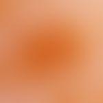 Ephelids: Incident light microscopy (forehead region): Yellowish-brown spot with irregularly bulg...