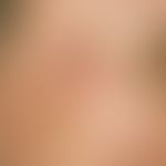 Epidermalzyste: prall elastischer, deutlich protuberierender, prall-elastischer, schmerzloser, au...