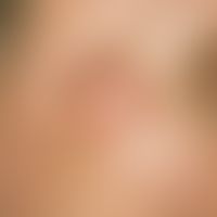 Epidermal cysts: bulging elastic, clearly protuberant, bulging elastic, painless, brown-red nodul...