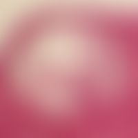 Epidermalzyste:&nbsp;große mit Horn gefüllte Epidermalzyste mit intakter Epithelauskleidung. Das ...
