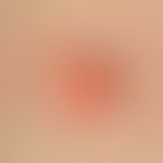 Epidermalzyste. 1 x 1 cm messender, gut abgrenzbarer, hautfarbener bis gelb-rötlicher, derber Kno...