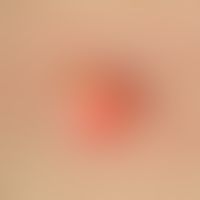 Epidermalzyste. 1 x 1 cm messender, gut abgrenzbarer, hautfarbener bis gelb-rötlicher, derber Kno...