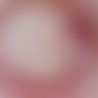 Epidermalzyste: Auflichtmikroskopie: Scharf begrenzter, verschieblicher, runder Knoten. Am untere...