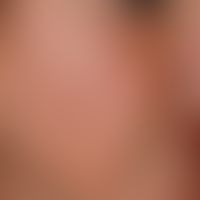 Epidermal cysts. 48-year-old female patient, skin change since 1 year, progressive. findings: Mul...