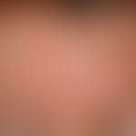 Epidermalzysten: seit ca. 1 Jahr bestehende disseminierte, chronisch stationäre, derbe, schmerzlo...
