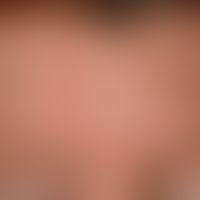 Epidermalzysten: seit ca. 1 Jahr bestehende disseminierte, chronisch stationäre, derbe, schmerzlo...