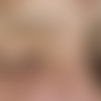 Indolent, deeply dermal, well definable, approx. 1.0 cm large, light yellow, plump elastic node w...