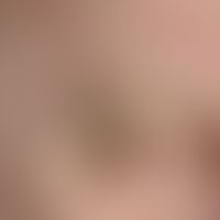 Epidermal cysts. multiple, chronically stationary (known for years), 0.2-0.5 cm large, well defin...