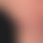 Epidermalzyste (rupturiert): großer früher schmerzloser, nach stumpfem Trauma schmerzhafter roter...
