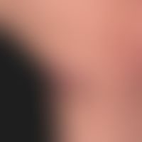 Epidermal cyst (ruptured)
