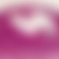 Epidermalzyste, proliferierende. Zystischer epidermaler Tumor. Der optisch leere Hohlraum war urs...