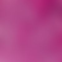 Epidermalzyste, proliferierende. Detailvergrößerung mit invasivem und destruierendem Wachstum ein...