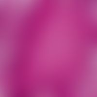 Epidermalzyste, proliferierende. Detailvergrößerung der linken Zystenwand. Hier invasives und des...