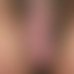 Epidermalzysten am Skrotum. Bei dem 45-jährigen Mann bestehen disseminierte, chronisch stationäre...