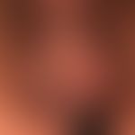Epidermalzysten am Skrotum (Sebocystomatosis scroti)
