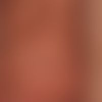 Epidermal cysts on the scrotum
