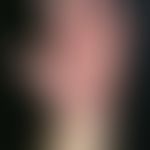 Epidermodysplasia verruciformis. Bei der 34-jährigen Patientin bestehen seit der Kindheit teils e...