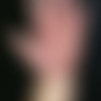 Epidermodysplasia verruciformis. Bei der 34-jährigen Patientin bestehen seit der Kindheit teils e...