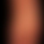 Epidermodysplasia verruciformis
