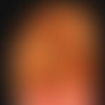 Epidermodysplasia verruciformis
