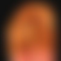 Epidermodysplasia verruciformis
