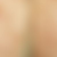 Epidermolysis bullosa junctionalis, non-Herlitz. extensive erythema and erosions next to large bl...